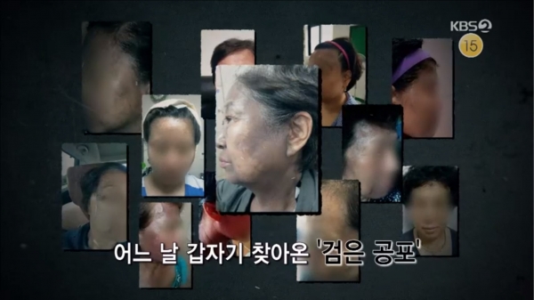 흑피증 피해를 호소하는 소비자들(KBS영상 캡처)